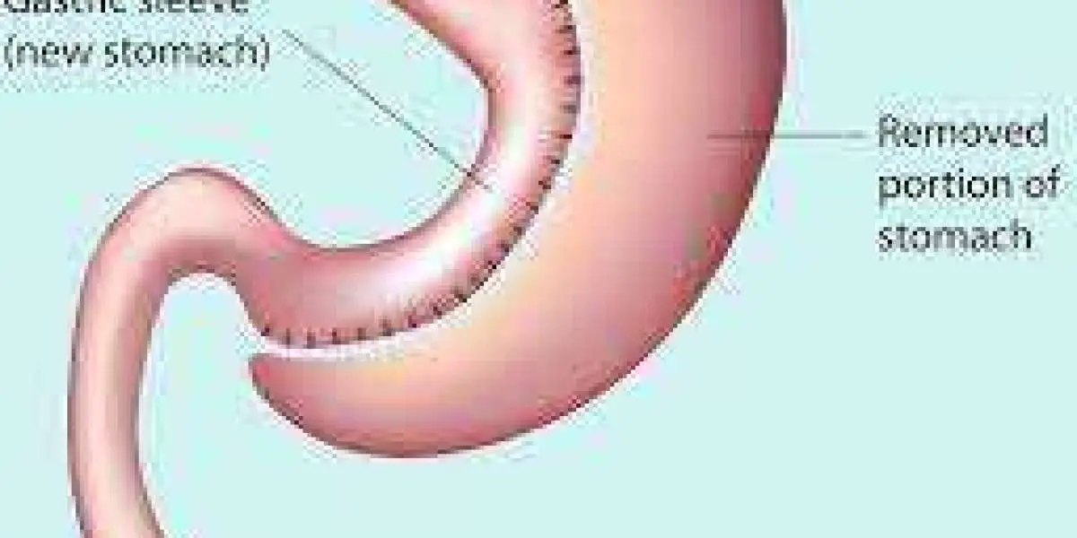 What does the cost of gastric sleeve surgery in Turkey typically include