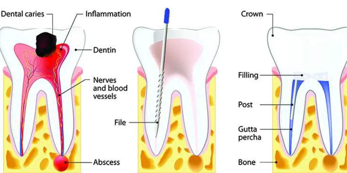Failed Root Canal | Symptoms & Treatment Options